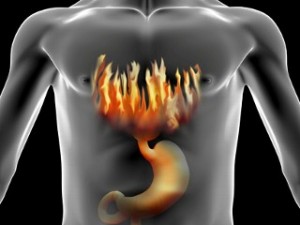 Heartburn, also known as acid reflux or gastroesophageal reflux 