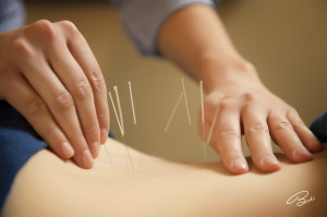 acupuncture for low back pain forest hill st clair toronto