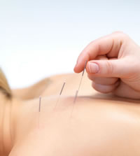 acupuncture for upper back pain st clair west forest hill toronto