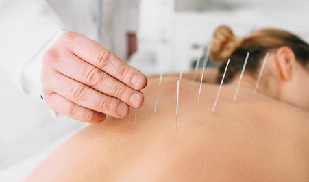 Acupuncture Vs. Dry Needling